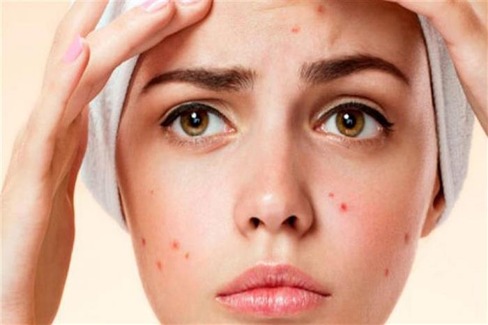 Acne may threaten teenagers with suicide.. Here are the treatment methods.